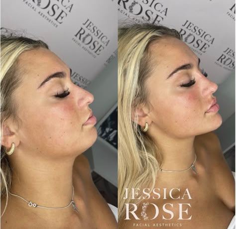 Plastic Surgery Jawline, Filler Face Contouring, Jaw And Cheek Filler, Chin Plastic Surgery Before After, Round Face Fillers, Chin And Cheek Fillers, Cheek And Jaw Fillers, Jaw Line Botox Before And After, Cheek And Chin Filler