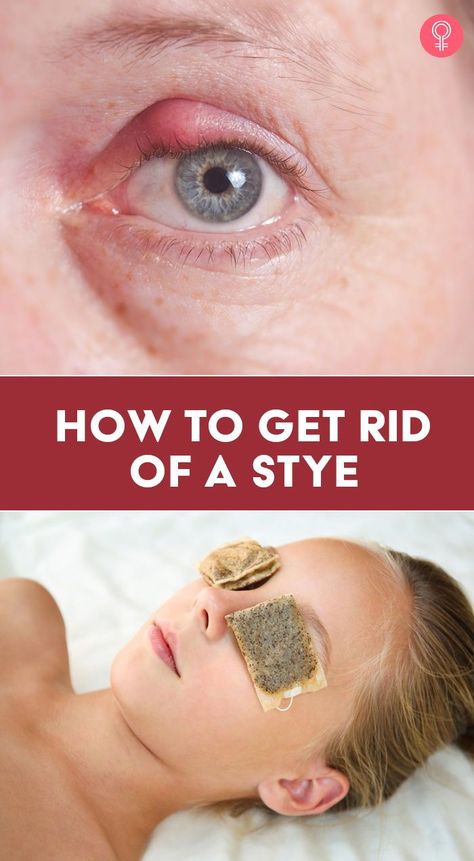 What To Do For A Sty In Your Eye, Sty Remedy How To Get Rid, Sty In The Eye Remedies How To Get Rid, Tea Tree Oil For Eye Stye, Get Rid Of A Stye Overnight, How To Get Rid Of A Stye On Your Eyelid, Stye Remedies Fast Essential Oils, Remedies For Stye On Eyelid, Stye Remedies Fast How To Get Rid At Home