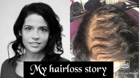 Introduction to hair female pattern baldness and my story Female Balding Hairstyles, Female Pattern Baldness Hairstyles, Fat Burning Pills, Female Pattern Baldness, Androgenetic Alopecia, Fue Hair Transplant, Pattern Baldness, Introduce Myself, Bald Hair