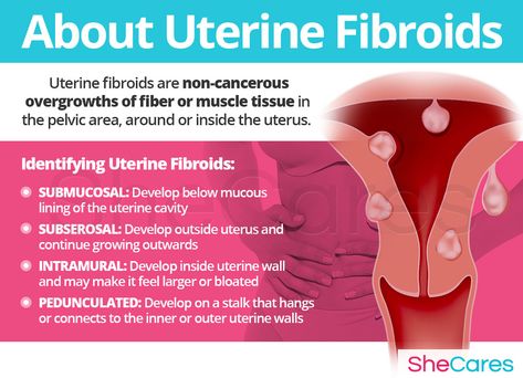 Uterine Fibroids | SheCares Polyps Uterus, Womb Chakra, Enlarged Uterus, Fibroid Symptoms, Uterine Polyps, Medical Laboratory Science Student, Ttc Tips, Fibroid Diet, Fibroid Uterus