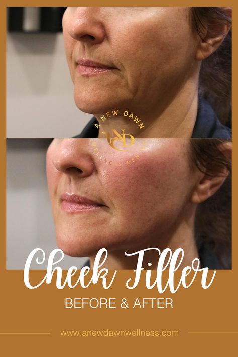 Cheek Filler Before & After from A New Dawn Wellness Center in Scottsdale, AZ Face Fillers Before And After Cheeks, Cheek Filler Before And After, Cheekbone Filler Before And After, Nasolabial Folds Dermal Fillers, Cheek Fillers Before And After Face, Cheek Injections, Er Nursing, Alice Clothes, Derma Fillers