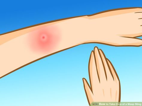 How to Take Care of a Wasp Sting: 8 Steps (with Pictures) Red Wasp Sting, Wasp Stings Relief, Wasp Sting Remedy, Hornet Sting, Wasp Sting, Remedies For Bee Stings, Red Wasps, Get Rid Of Wasps, Sting Relief