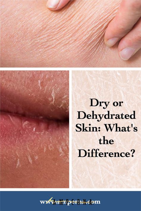 Dull Dry Skin, Dehydrated Skin Face, Dry Vs Dehydrated Skin, Skincare For Dehydrated Skin, Dehydrated Skin Care Routine, Dehydrated Face, Dry Face Skin, Dry Peeling Skin, Sunburn Peeling