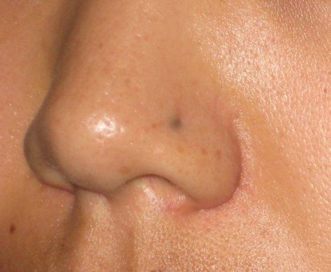 When the skin around the site of a piercing turns gray, this is known as "argyria" Nose Piercing Scar, Nose Piercing Healing, Least Painful Piercings, Dark Spots Under Eyes, Get Rid Of Spots, Age Spots On Face, New Ear Piercing, Age Spot Removal, Dark Spots On Face