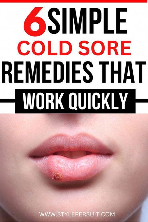 Cold Sore Remedies, Cold Sore Relief, Home Remedies For Allergies, Home Remedies For Warts, Warts Remedy, Fever Blister, Natural Remedies For Migraines, Sunburn Relief, Cold Sores