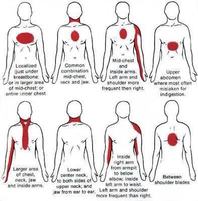 Chest pain Penyakit Jantung, Nursing Tips, Medical Knowledge, Chest Pain, Medical Information, Health Info, Heart Health, Nut Butter, Nurse Life