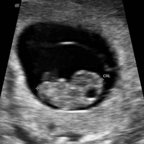 Week 8-1255963362088.xml 8 Week Ultrasound, Fake Ultrasound, Baby Ultrasound Pictures, Pregnancy Images, Sonogram Pictures, Baby Weeks, Pregnancy Ultrasound, Baby Ultrasound, Development Milestones