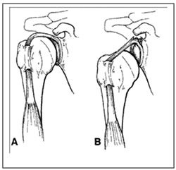 Managing Expectations When Recovering from Labral Repair Shoulder Surgery Recovery, Managing Expectations, Rotator Cuff Surgery, Shoulder Rehab, Rotator Cuff Tear, Shoulder Impingement, Shoulder Injury, Rotator Cuff Injury, Cough Medicine