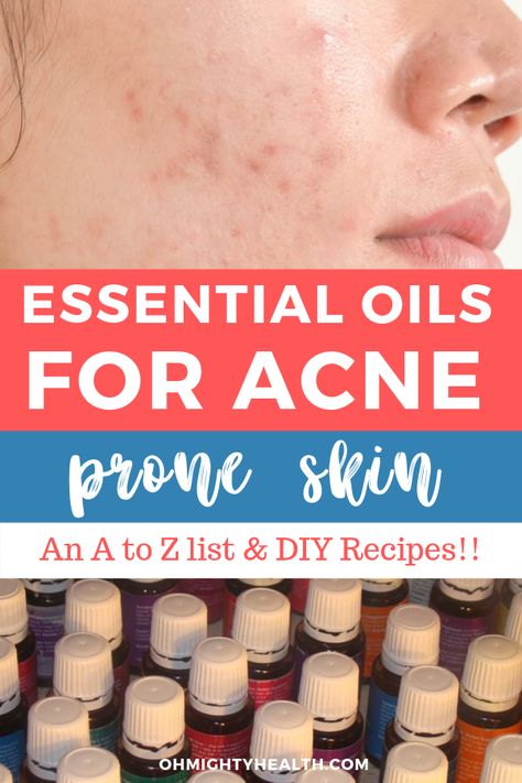 Essential Oil For Oily Skin, Face Serum For Oily And Acne Prone Skin, Face Serum For Acne Prone Skin, Face Oil For Acne Prone Skin, Diy Moisturizer For Acne Prone Skin, Diy Serum For Acne Prone Skin, Oils For Acne Prone Skin, Essential Oils For Acne, Oils For Acne