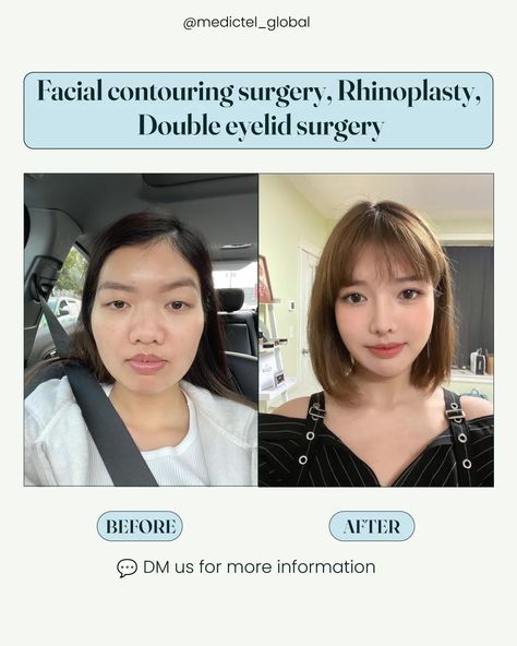 More info about her plastic surgery in Korea ⬇️ Here are the procedures that she underwent:  ✅️ Facial contouring surgery: cheekbone reduction, jaw angle reduction & genioplasty ✅️ Rhinoplasty: silicon implant, donor rib cartilage, ear cartilage & alar base reduction ✅️ Double eyelid surgery non-incision method In Korea 🇰🇷 , it's common to undergo several plastic surgery procedures at once. This method allows for one recovery period and can be more economical.💡 👉 That's where we come in... Facial Contouring Surgery, Jaw Angle, Cheekbone Reduction, Plastic Surgery Korea, Silicone Implants, Reduction Surgery, Facial Contouring, Plastic Surgery Procedures, Double Eyelid