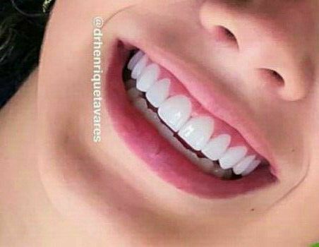 Perfect Teeth Smile, Teeth Makeover, Teeth Aesthetic, Pretty Teeth, Bentuk Alis, Veneers Teeth, Beautiful Teeth, Straight Teeth, Perfect Teeth