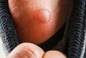 related content Blood Blister, Skin Blisters, Heel Blisters, Bug Bite, Face Home, Health Topics, Mosquito Bite, Bug Bites, A Bug