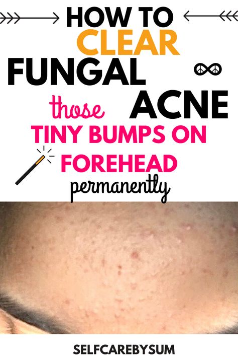 How to clear fungal acne: those tiny bumps on forehead - Self-Care by Sum #acne #pimples #pimplesremedies #acneremedies #skincarediy. https://whispers-in-the-wind.com/combatting-pimples-under-the-skin-expert-tips-and-product-recommendations/?135 Bumpy Forehead Remedy, Fungal Acne On Forehead, Nizoral For Fungal Acne, How To Treat Fungal Acne, Fungal Acne Skin Care Routine, Tiny Bumps On Forehead, Acne On Forehead, Treat Fungal Acne, Small Bumps On Forehead