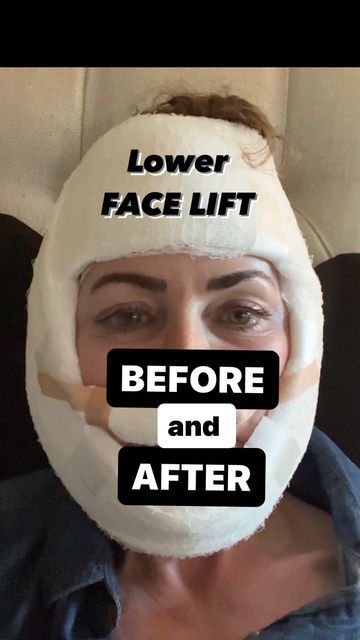 Lower Facelift Before And After, Lower Face And Neck Lift, Liquid Facelift Before After, Chin Lift Before And After, Facelift Recovery Day By Day, Before And After Face Lift, Face Fat Loss Before And After, Neck Lipo Before And After, Face Lift Before And After