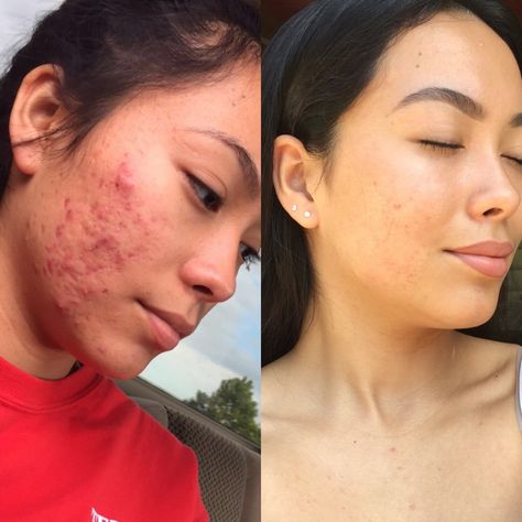 My before and after acne transformation ✨ I quit dairy 6 months ago and haven’t looked back! I have a new video on my YouTube channel talking more about it please check it out ❤️ https://youtu.be/CsubDPZwvvU Acne Before After, Before After Aesthetic, Skincare Before And After, Acne Before And After, Acne Transformation, Dark Joke, Girl With Acne, Acne Positivity, Before And After Acne