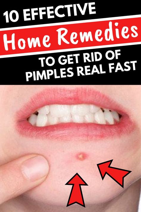 How To Get Rid Of A Pimple Fast At Home, How To Get Rid Of A Pimple In 5 Minutes, Get Rid Of Zits Overnight, Dettol Antiseptic, Deep Pimple, Anti Acne Face Mask, Get Rid Of Pimples Overnight, Rid Of Pimples Overnight, Rid Of Acne Overnight