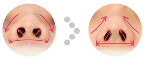 How to fix flat, wide nose in one day. ☞Here we have a quick, easy, long-lasting solution for your wide, flat, thick, bulbous nose that can be done in just 10 minutes. Why is this K-Nose So Awesome? How is it possible in just 10 short minutes? Take a look and get your mind blown! K-Nose : One day Nose job, more specifically, Non-incision nasal tip-plasty is a procedure using specially-designed thread to reshape, refine, correct the nose(nasal) tip leaving no scars from surgical incision. - See m Tip Plasty Nose, Nose Fillers, Short Nose, Crooked Nose, Bulbous Nose, Nose Jobs, Nose Reshaping, Rhinoplasty Surgery, Wide Nose