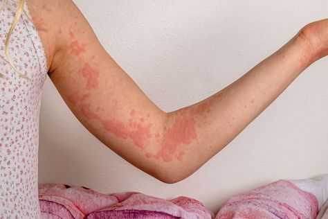 Autoimmune hives can appear when the body’s natural defense system attacks normal cells and tissues. Here’s what to know about autoimmune urticaria. How To Treat Hives, Allergy Hives, Fever Rash, Chronic Hives, Types Of Rashes, Natural Medicines, Common Medications, Skin Bumps, Medical Terminology