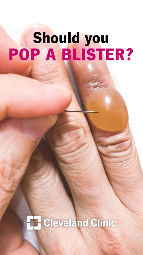 Should you pop or break a blister? Blister In Mouth, How To Treat Blisters, Water Blister, Blister Remedies, Sunburn Blisters, Blister On Lip, How To Heal Blisters, Blister Care, Blood Blister