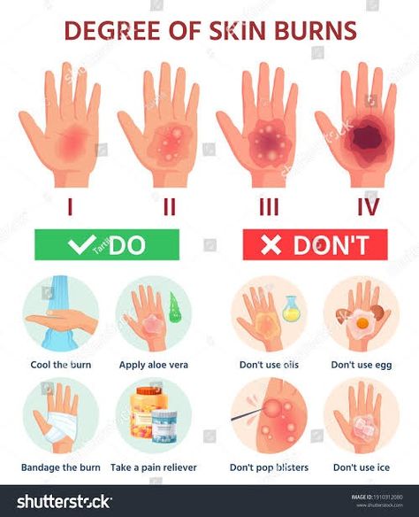 Burn Wound, First Aid Poster, First Aid For Burns, Emt Study, Burn Injury, First Aid Tips, Degree Burns, Survival Skills Life Hacks, Skin Burns