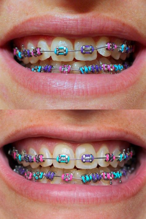 Best Color For Braces, Rainbow Braces, Braces Girl, Braces Colors Combinations, Invisible Teeth Braces, Natural Teeth Whitening Diy, Cute Braces Colors, Kids Braces, Braces Tips