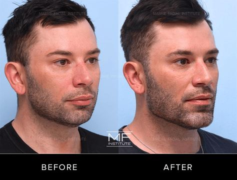 Case 726: Photos depicting a man before and after chin jawline dermal filler in San Francisco, CA Male Jaw Filler, Mens Jawline Filler, Mens Lip Filler, Jawline Before And After, Looksmaxxing Men, Jawline Fillers Before And After, Male Jawline, Jaw Filler, Liquid Rhinoplasty