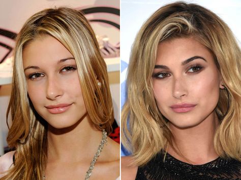 Hailey Baldwin in 2011 (left) and in 2016 (right). Face Plastic Surgery, Rhinoplasty Nose Jobs, Celebrity Plastic Surgery, Celebrities Before And After, Eye Surgery, Bright Blonde, Nose Job, Lip Fillers, Hailey Baldwin