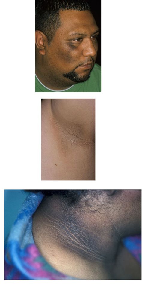 ACANTHOSIS NIGRICANS is a brown to black, poorly defined, velvety hyperpigmentation of the skin. It is usually found in body folds, such as the posterior and lateral folds of the neck, the axilla, groin, umbilicus, forehead, and other areas. The most common cause of acanthosis nigricans is insulin resistance, which leads to increased circulating insulin levels. It is also a prominent feature of obesity| Read more here http://en.wikipedia.org/wiki/Acanthosis_nigricans Neck Hyperpigmentation, Medical Esthetics, Hyperpigmentation Black Skin, Acanthosis Nigricans, Hormonal Imbalance, Dark Complexion, Medical Dental, Skin Care Clinic, Skin Diseases