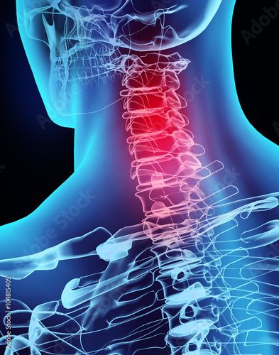 Stock Image: 3D illustration x-ray neck painful. Upper Cervical Chiropractic, Whiplash Injury, Ligament Tear, Forward Head Posture, Neck Injury, Head Pain, Upper Back Pain, Whiplash, Traffic Light