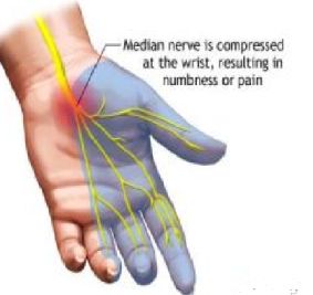 Compression an injury to the median nerve causes numbness and tingling mostly affecting the thumb, index finger, middle  finger, and half of the ring finger. Description from mmcneuro.wordpress.com. I searched for this on bing.com/images Doterra Dogs, Carpal Tunnel Exercises, Carpal Tunnel Relief, Median Nerve, Trigger Point Therapy, Hand Pain, Shin Splints, Hand Therapy, Nerve Damage