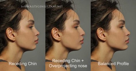 Nose Surgery Rhinoplasty, Chin Filler, Plastic Surgery Fail, Chin Augmentation, Chin Implant, Rhinoplasty Nose Jobs, Plastic Surgery Gone Wrong, Face Surgery, Big Nose Beauty