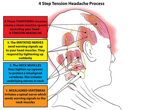 Tension headaches usually affect both sides of the head and last from thirty minutes to several days or more. TTH are by far the most common type of chronic h Punkty Spustowe, Relief Headache, Tension Headache Relief, Headache Relief Instant, Throbbing Headache, Headache Types, Essential Oils For Headaches, Trigger Point Therapy, Natural Headache Remedies