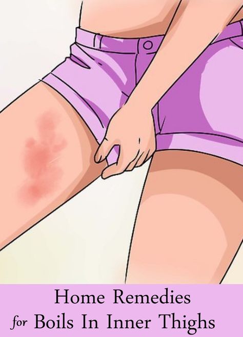 Home Remedies For Boils In Inner Thighs Inner Thigh Bumps, Inner Thigh Pimples, Inner Thigh Boils, Inner Thigh Rash, Boil Remedies, Get Rid Of Boils, Home Remedy For Boils, Skin Boil, Rashes Remedies