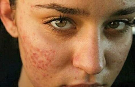 Why Acne Doesn’t Make You Any Less Beautiful Girl With Acne, Pimples Under The Skin, Bad Acne, Pele Natural, Natural Acne Remedies, Natural Acne, Acne Scar Removal, Best Teeth Whitening, Acne Remedies