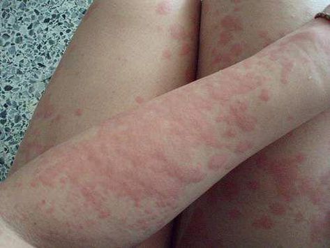 What do bed bugs, tick bites and mosquito bites all have in common? For the most part, they all leave some types of rashes of some kind that shouldn't be Heat Rash On Face, Heat Rash Remedy, Skin Rashes Pictures, They All Leave, Prickly Heat Rash, Leg Rash, Body Rash, Rash On Face, Rashes Remedies