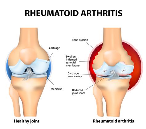 Phase 2 Trial Results of Mesoblast’s Cell Therapy Show Dose-Related Improvements… Arthritic Pain, Healthy Joints, Autoimmune Disease, Knee Pain, Vitamin D, Nerve, Chronic Pain