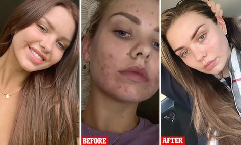 Makeup Acne, Fresh Face Makeup, Acne Makeup, Hormonal Acne, Face Acne, Fresh Face, Gold Coast, Daily Mail, Beauty Tips