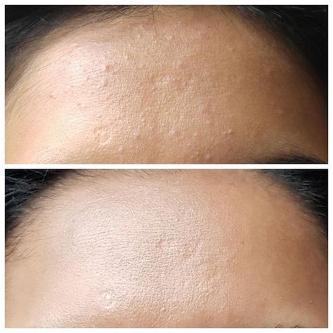 One Reddit user may have discovered a holy-grail product for removing whitehead blemishes from skin. Click here to see how it works. Closed Comedones, Whiteheads Remedy, Blind Pimple, Pimples Under The Skin, Natural Beauty Remedies, Natural Acne Remedies, Body Hair Removal, Acne Remedies, Unwanted Hair Removal