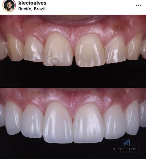 Before and after porcelain Veneers from doctor klecioalves.  The top photos is the before picture, the teeth are yellow and chipped. The Bottom photo is the after picture which is a perfect white smile. Teeth Surgery Before And After, Perfect Smile Teeth Porcelain Veneers, Prosthodontics Day Posters, Dental Veneers Before And After, Teeth Veneers Before And After, Dental Before And After, Porcelain Veneers Before And After, Composite Veneers Before And After, Veneers Before And After