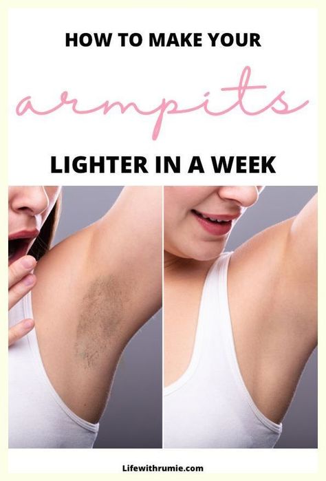 How To Whiten Underarms Fast and Naturally How To Make Your Armpits Lighter, Underarm Darkness Remedies, Postpartum Skincare, Whiten Underarms Fast, Acanthosis Nigricans, How To Whiten Underarms, Dark Armpits, Underarm Odor, Underarm Hair Removal