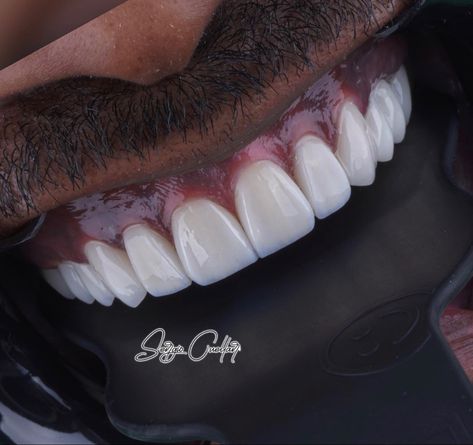 Porcelain Veneers by drsergio. Cuellar Porcelain Veneers, Makeup Tips, Porcelain, Lips, Makeup, Quick Saves, Make Up