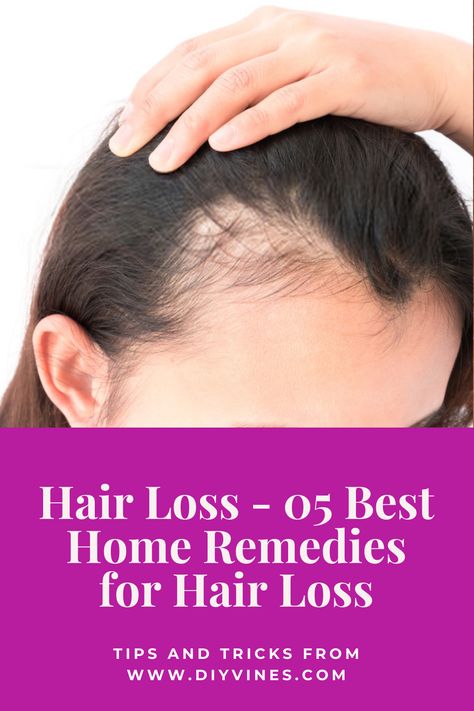 Hair Loss - 05 Best Home Remedies for Hair Loss #beauty #beautytips #skincare #skincaretips #remedies #homeremedies #DIY #haircare #hair #hairloss #hairgrowth #hairregrowth Diy Haircare, Natural Hair Growth Remedies, Hair Falls, Brown Spots On Face, Home Remedies For Hair, Lost Hair, Stimulate Hair Growth, Hair Remedies, Natural Shampoo