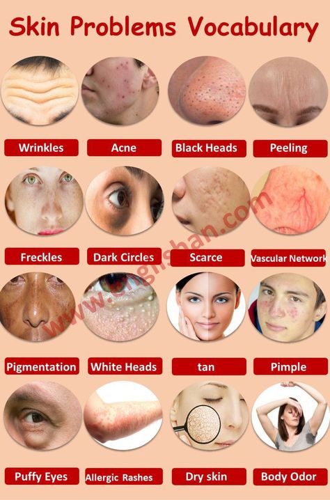 Blackhead Remedies, Blackheads On Nose, Acne Help, Skin Advice, Natural Skin Care Remedies, Rid Of Blackheads, Types Of Skin, Basic Skin Care Routine, Moisturizer For Oily Skin