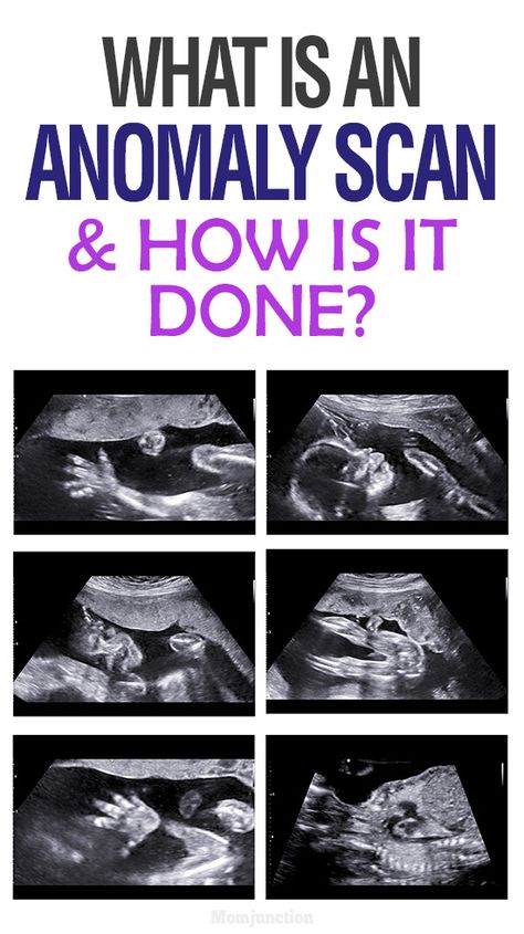 What is an Anomaly Scan And How Is It Done? 19 Weeks Pregnant Ultrasound, 20 Week Ultrasound Pictures, 20 Weeks Pregnant Ultrasound, 12 Week Ultrasound Pictures, 12 Week Ultrasound Gender, 19 Weeks Pregnant Belly, 19 Week Ultrasound, Ultrasound Pictures Gender, Boy Ultrasound Pictures