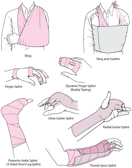 Overview of Fractures, Dislocations, and Sprains - Injuries and Poisoning - Merck Manuals Consumer Version Bandage Arm Aesthetic, Doctor Pose Reference, Bandaged Arm, Shoulder Dislocation, Supraviețuire Camping, First Aid Tips, Medical Procedures, Bone Fracture, Medical School Studying