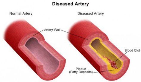 Erectile Dysfunction Remedies, Varicose Vein Remedy, Blood Pressure Symptoms, Carotid Artery, Arteries And Veins, Blood Pressure Chart, Clogged Arteries, Back Pain Remedies, Normal Blood Pressure