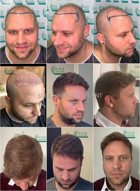 Get the best hair transplant operation in sule hair transplant Cowboy Cerrone, Best Hair Transplant, Hair Transplant, Best Hair, Men's Style, Womens Hairstyles, Cool Hairstyles, Mens Sunglasses, Cowboy