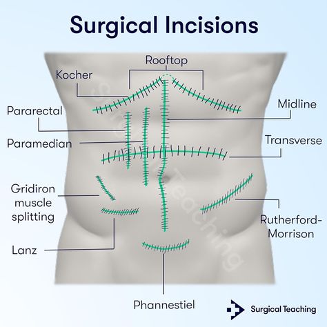 4,539 Likes, 18 Comments - Surgical Teaching (@surgicalteaching) on Instagram: “Do you know the different types of Surgical Incisions?⁠ ⁠ Want to learn more essential information…” Surgical Incisions, Medical Assistant Student, Physical Therapy Student, Medical School Life, Nursing School Motivation, Medicine Notes, Basic Anatomy And Physiology, Medicine Studies, Nurse Study Notes