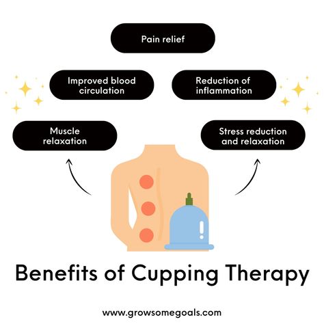 Elevated essential: cupping therapy. Check these five health benefits of cupping therapy. Cupping therapy should be performed by a trained and qualified acupuncturist. We offer acupuncture services, call and book your appointment! Fire Cupping Therapy, Benefits Of Cupping Therapy, Benefits Of Cupping, Message Therapy, Massage Pictures, Fire Cupping, Eastern Medicine, Sports Therapy, Cupping Therapy