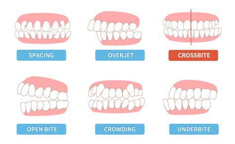 When teeth align correctly, upper teeth naturally fit on the outside of lower teeth. Chewing and biting are painless and easy with correct alignment. Poorly aligned bites, on the other hand, can lead to problems like cracked or broken teeth and/or worn enamel due to the repeated irregular contact between upper and lower teeth. Rotten Teeth, Broken Teeth, Cracked Tooth, Teeth Alignment, Clear Braces, Crooked Teeth, Tooth Removal, How To Prevent Cavities, Root Canal